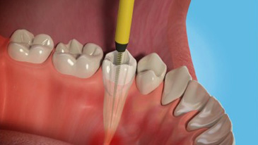 Root Canal Treatment